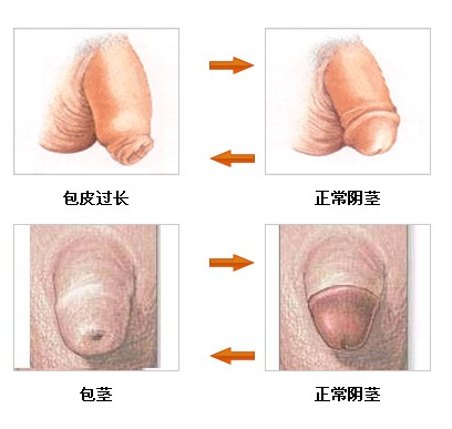 怎样才算包皮过长