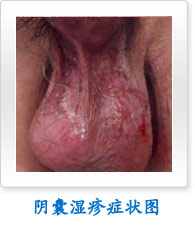 阴囊湿疹症状图